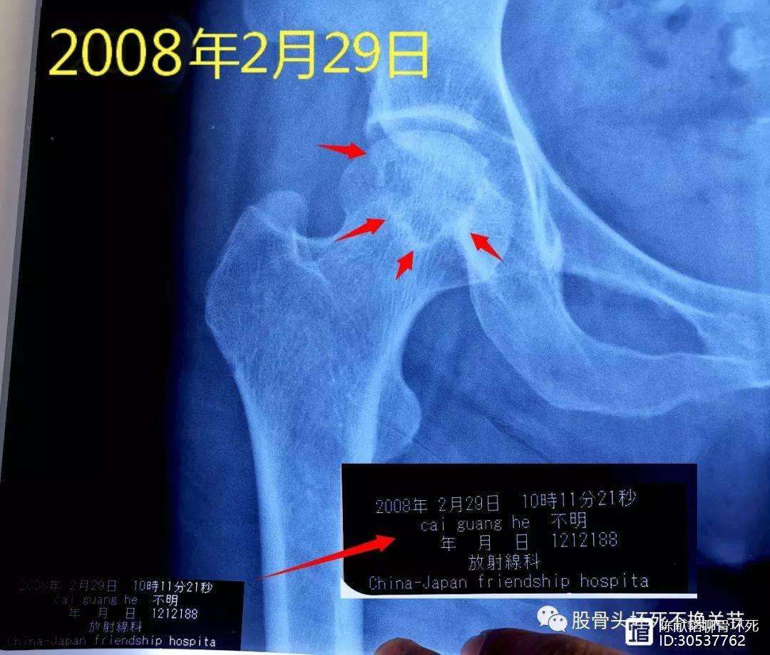 本溪人工骨头医保报销多少(人工骨头医保报销多少比例)